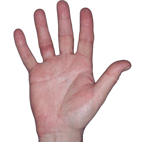 Case 5, Week 8: IGA-CHE score: 2. HESD-Itch score: 0.6. HESD-Pain score: 0.3