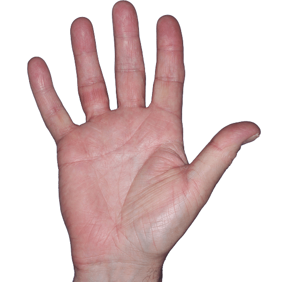 Case 5, Week 16: IGA-CHE score: 1. HESD-Itch score: 0.1. HESD-Pain score: 0.1