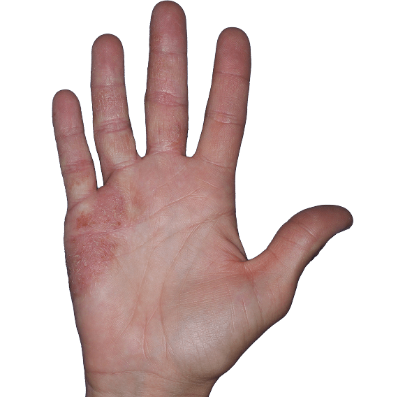 Case 6: At Baseline, patient has erythema and scaling. IGA-CHE score: 3. HESD-Itch score: 7.7. HESD-Pain score: 6.1