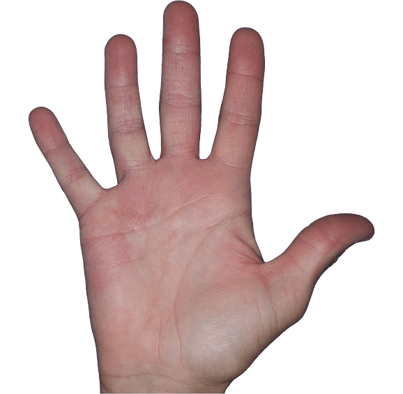 Case 6, Week 4: IGA-CHE score: 1. HESD-Itch score: 0.7. HESD-Pain score: 0.1