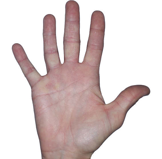 Case 6, Week 16: IGA-CHE score: 1. HESD-Itch score: 0. HESD-Pain score: 0