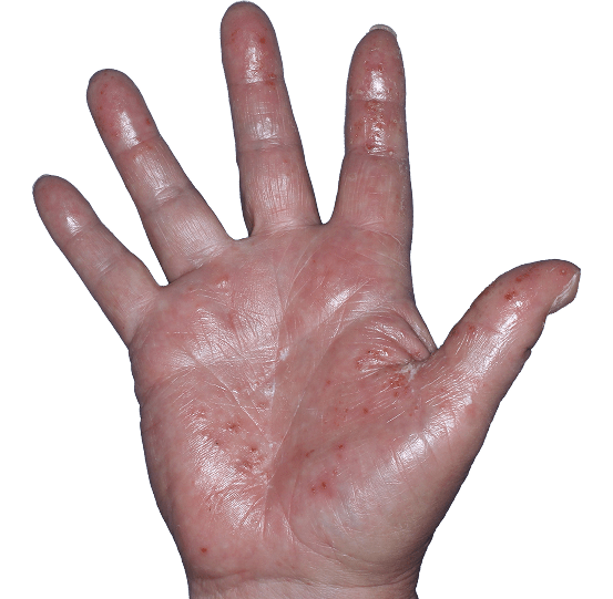 Case 7: At Baseline, patient has vesicles, erythema, and edema. IGA-CHE score: 3. HESD-Itch score: 6.8. HESD-Pain score: 6.5.