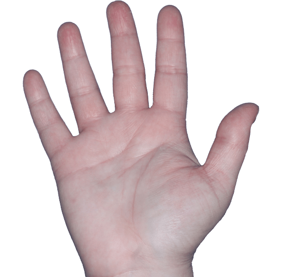 Case 7, Week 4: IGA-CHE score: 3. HESD-Itch score: 6.6. HESD-Pain score: 6.2