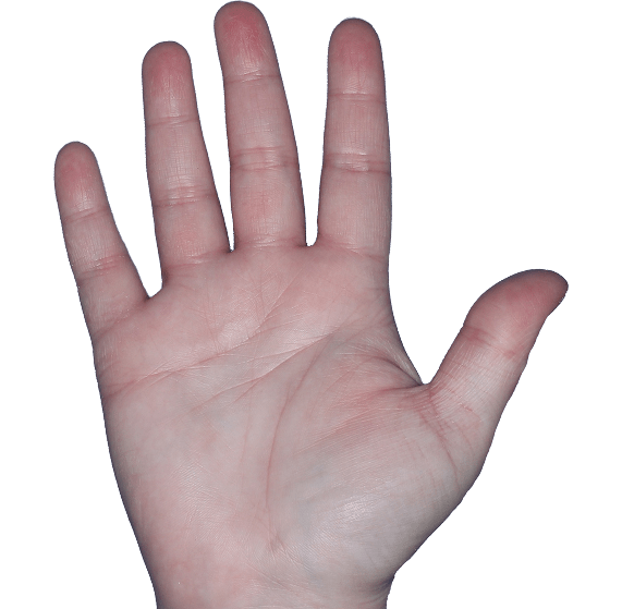 Case 7, Week 8: IGA-CHE score: 3. HESD-Itch score: 5.3. HESD-Pain score: 5.4