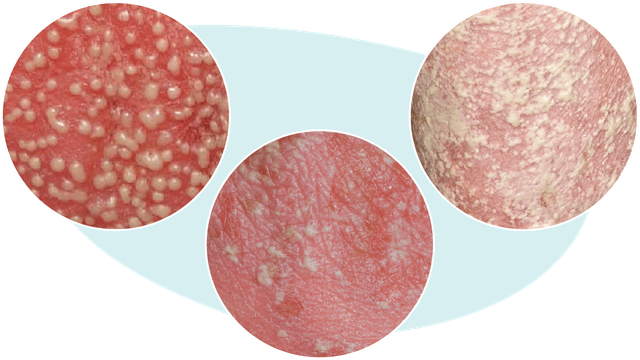 Three images showing painful pustules that can look like pimples or whiteheads and may cover large areas of the body