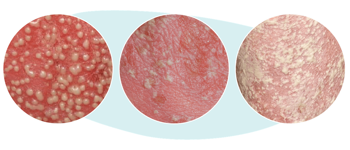 Three images showing painful pustules that can look like pimples or whiteheads and may cover large areas of the body