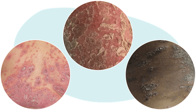Three examples of GPP symptoms with red, scaly, or discolored skin in different skin tones