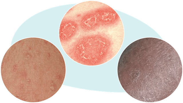 Examples of skin affected by GPP, showing redness, blisters, and scaling between flares
