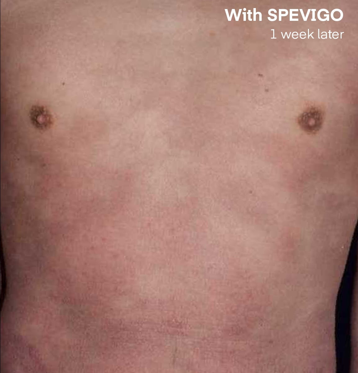 Symptoms with Spevigo 1 week later.