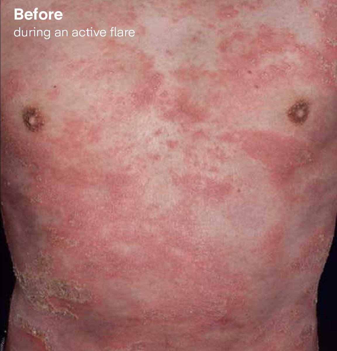 Symptoms before Spevigo during an active flare.