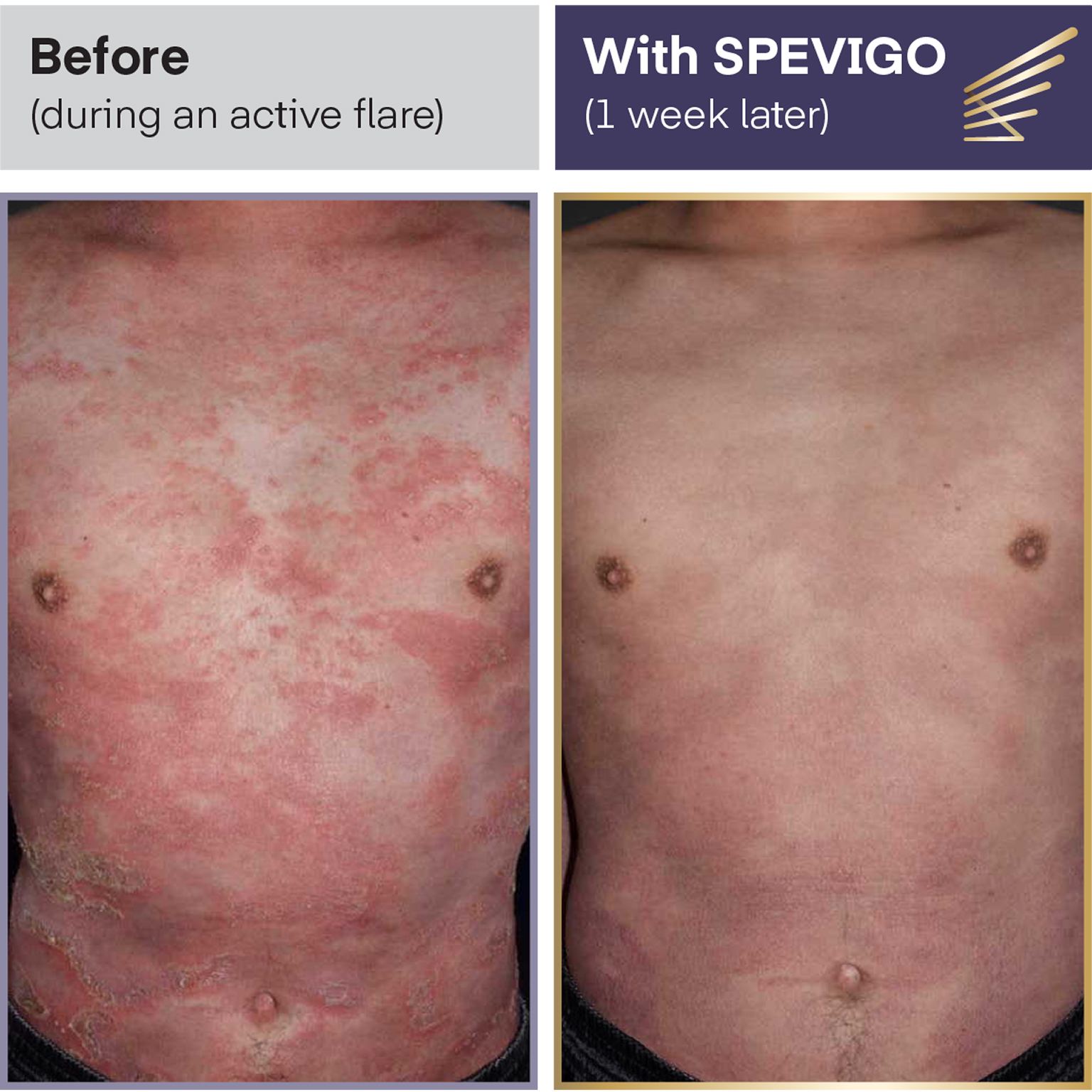 Before Spevigo (during an active flare). With Spevigo (1 week later).