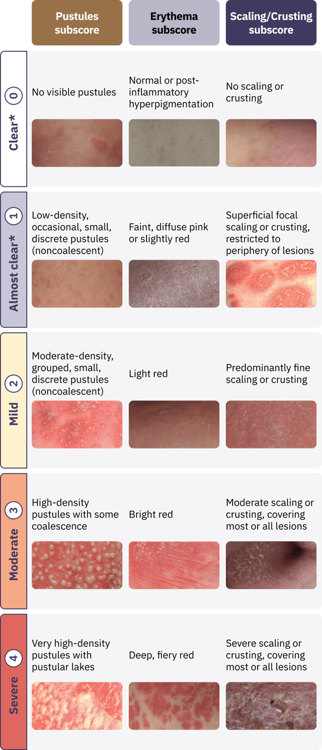 Gpp Rash What is GPP? (About GPP) | SPEVIGO® HCP