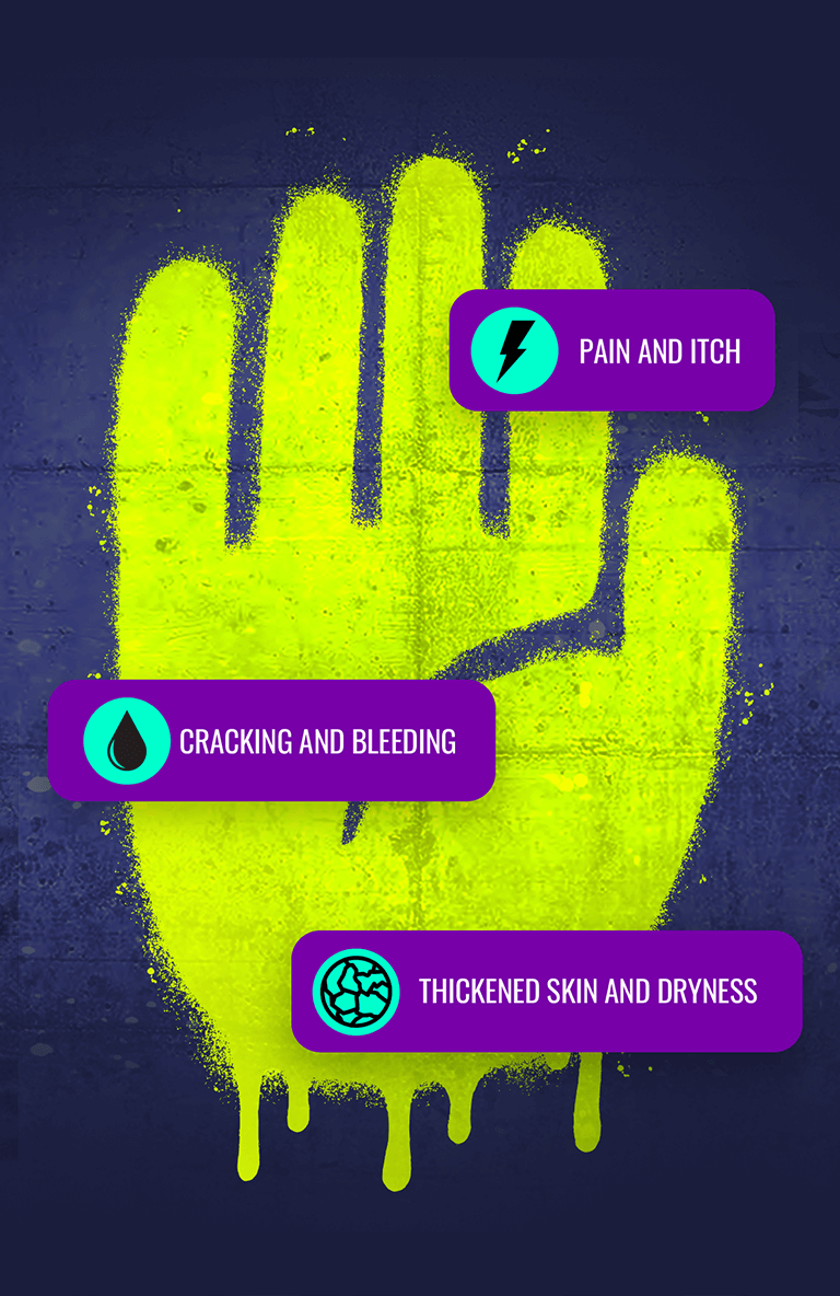 Illustration of a hand with labels indicating symptoms of chronic hand eczema, including pain, itching, cracking, bleeding, and thickened skin.
